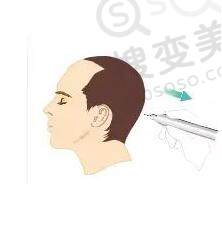 FUE植发会留疤吗？