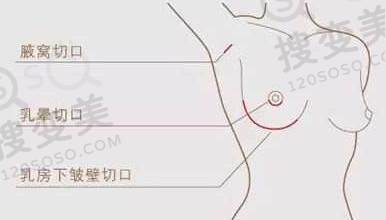 假体隆胸的切口该如何选择？