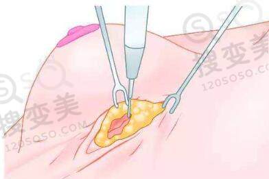假体隆胸的切口该如何选择？