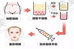 杭州脂肪填充、吸脂、隆胸医院医生攻略大全