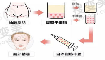 广州自体脂肪填充和吸脂好的医院医生