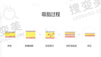 广州自体脂肪填充和吸脂好的医院医生
