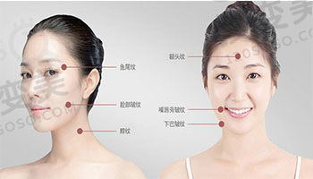 什么是埋线提升以及术后注意事项