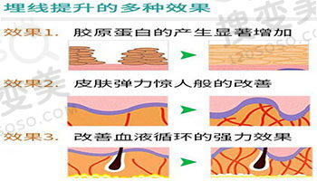 什么是埋线提升以及术后注意事项