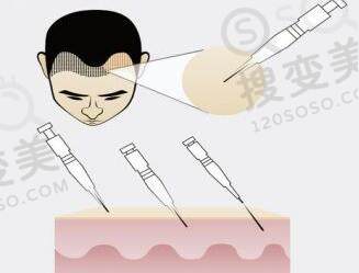 植发对身体有什么伤害吗？