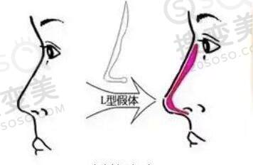假体隆鼻出现肿胀和假体外露的原因是什么？