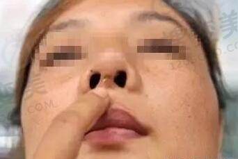 假体隆鼻出现肿胀和假体外露的原因是什么？