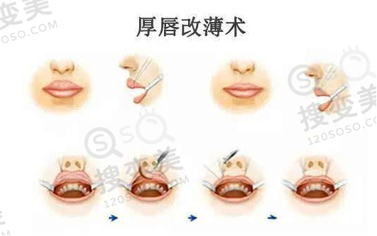 厚唇改薄有什么风险和副作用