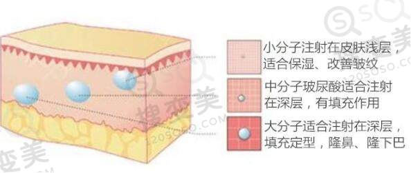玻尿酸丰耳垂安全吗？