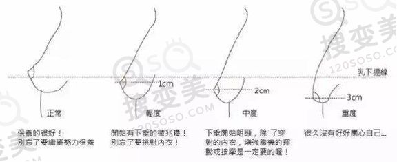乳房下垂