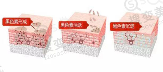 黑眼圈的形成