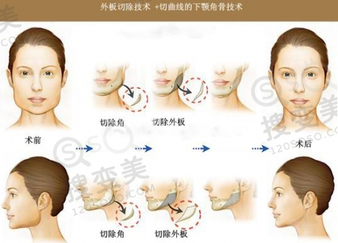 下颌角整形手术过程