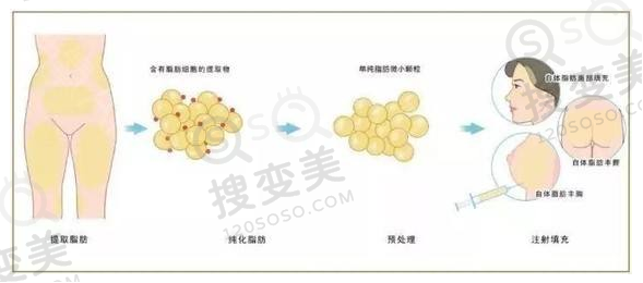 自体脂肪填充示意图