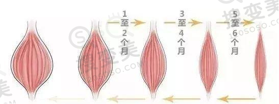 塑形针