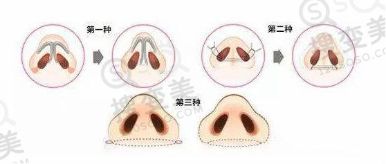 鼻翼缘解决方法