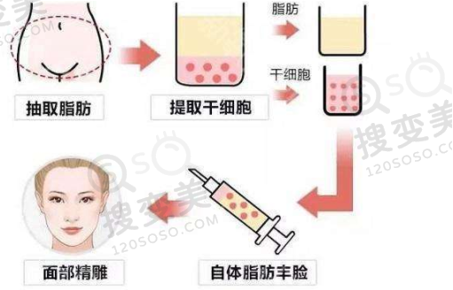 自体脂肪填充过程