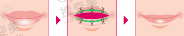 厚唇改薄