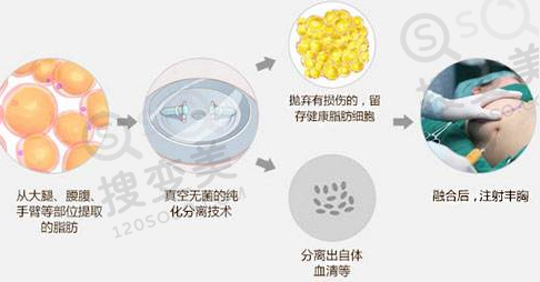 自体脂肪隆胸术后需要按摩吗？