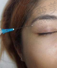 双眼皮注射麻yao