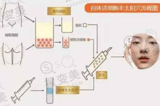 自体脂肪填充太阳穴需要填充几次？