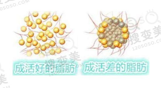 自体脂肪填充