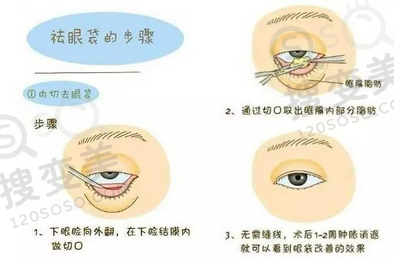去眼袋的方法有哪些？