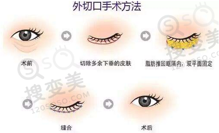外切去眼袋的手术过程