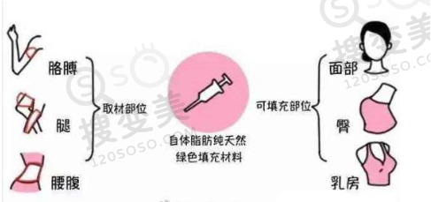 自体脂肪填充