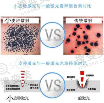 皮秒洗眉和传统洗眉的区别