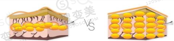 脂肪不够可以用别人的脂肪填充吗？
