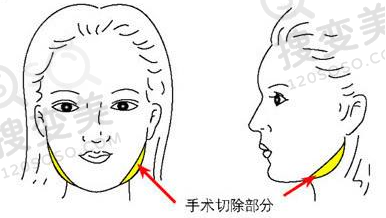 下颌角整形手术