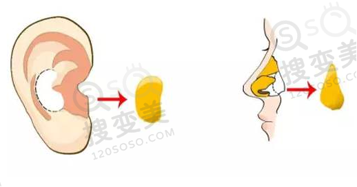 自体耳软骨垫鼻尖图