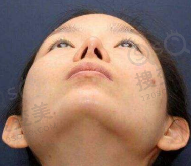 隆鼻术后出现鼻孔不对称的原因有哪些？