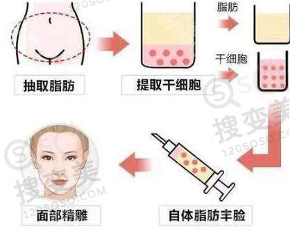 自体脂肪填充面部如何快速消肿？