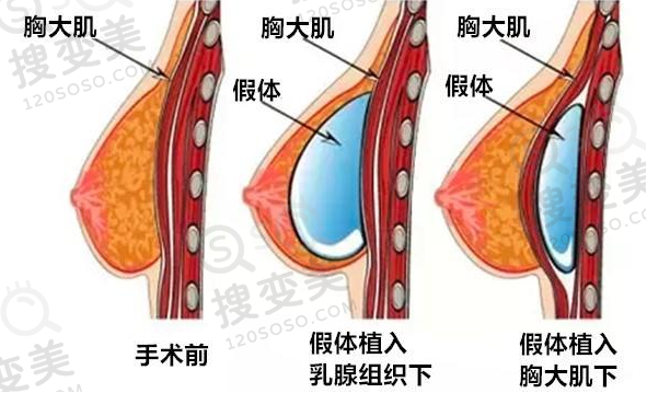 假体隆胸手感比较硬怎么办？