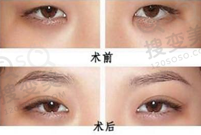 双眼皮术后什么时候涂祛疤膏?