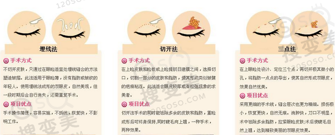 双眼皮手术方法