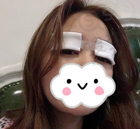 双眼皮术后贴纱布