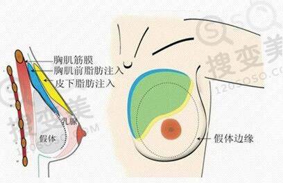 假体隆胸