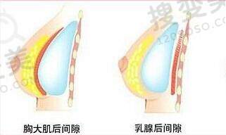 假体隆胸