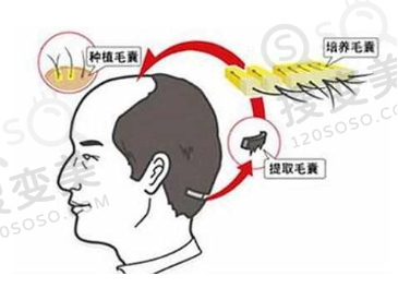 植发