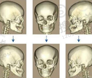 磨骨前后对比图