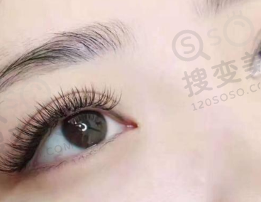 哪种情况适合做埋线双眼皮？