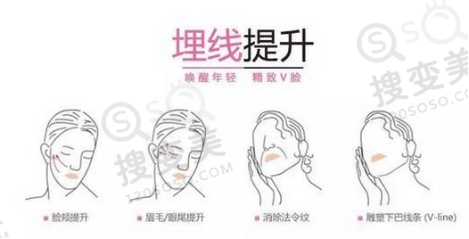 埋线提升部位