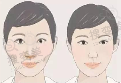 颧骨内推手术前后对比图
