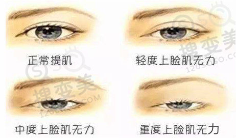 睁眼无力
