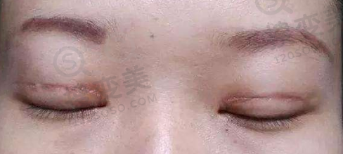 双眼皮术后疤痕明显
