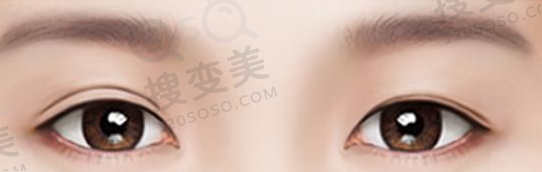 双眼皮术后大小眼