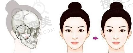 颧骨内推前后对比图