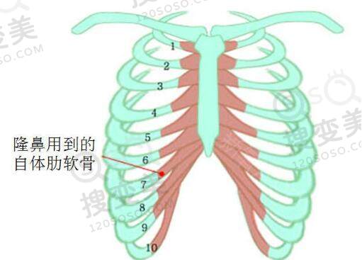 肋软骨隆鼻应该选择半肋还是全肋好呢？